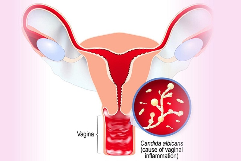 Tác nhân hay gặp nhất là nấm candida.